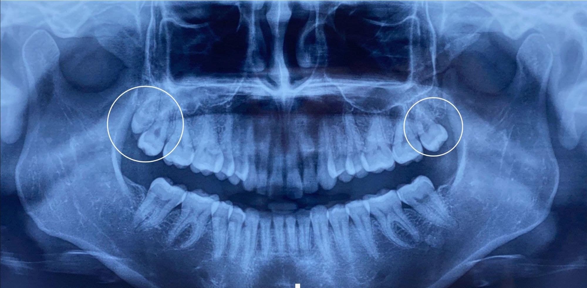 Radiografía panorámica con las muelas del juicio señaladas con un círculo